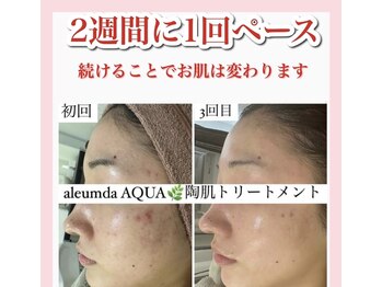 ホワイトアクア 天王寺本店(WHITE AQUA)/ハーブピーリング/大阪/天王寺