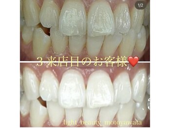 ライトビューティー 本八幡店(LIGHT BEAUTY)/【セルフホワイトニング】