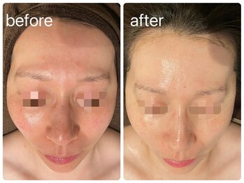 エヌエースキン 武蔵小杉店(Naskin)/赤み・ポツポツの気になるお肌！