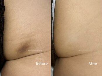アールビューティー(R Beauty)/お尻の黒ずみ劇的改善