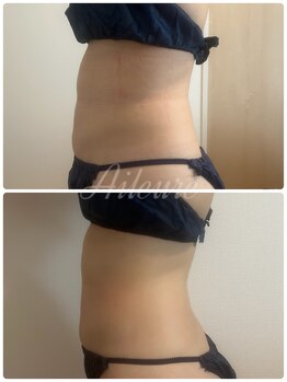 エルール トータルビューティ(Aileure total beauty)/ダウンタイムケアインディバ