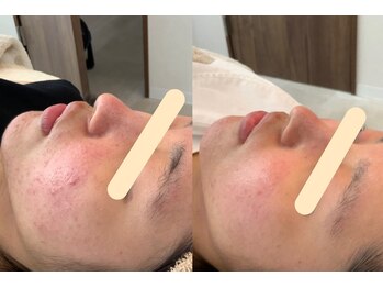 エスポワール(espoir)/初回before・２回目before