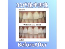 ホワイトニングショップ 西原店/30代後半男性☆BeforeAfter
