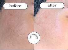 ユヌランコント 岐阜店(Une rencontre)/エンビロン（ピーリング）