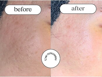 ユヌランコント 岐阜店(Une rencontre)/エンビロン（ピーリング）