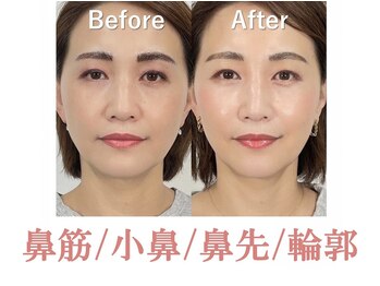 ラプリボヤージュ 藤沢店(Raplit)/隆鼻＋輪郭矯正40分10回コース