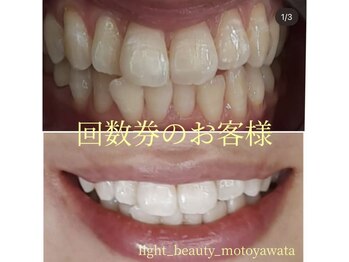 ライトビューティー 本八幡店(LIGHT BEAUTY)/【セルフホワイトニング】