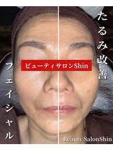 シン(Shin)/【たるみ改善フェイシャル】