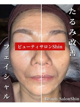 シン(Shin)/【たるみ改善フェイシャル】