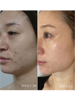 ラリマ(La-lima)/私自身の肌変化