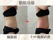 ウィボーテ(We Beaute)/【痩身】脂肪冷却×脂肪分解