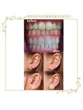 ココホワイトニング(coco whitening)/【美白＆耳つぼジュエリー】