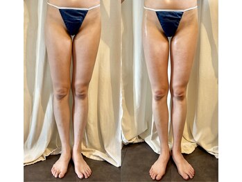 カルナ(CARNA)/【痩身】セルライトゼロ2