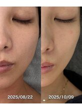 ビジュープラス 倉敷店(Bijou+)/【美白ケア】ハーブピーリング