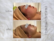 ジュプン 長崎/復元パックのお客様！