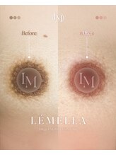 ルアナ(LUANA。)/ルメラ乳輪ビフォーアフター