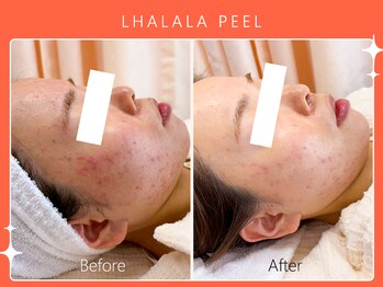 シロカネ イオンタウン西熊本店(SHIROKANE)/韓国肌管理ララピール☆