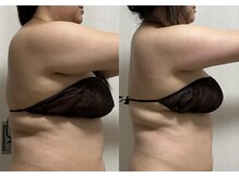 痩身・美肌管理専門店　private salon pixie【ピクシー】/施術1回の効果写真です。