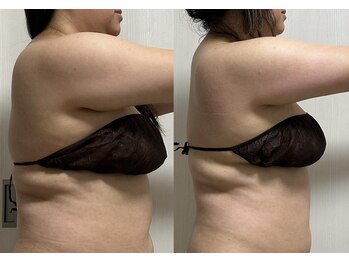 痩身・美肌管理専門店　private salon pixie【ピクシー】/施術1回の効果写真です。