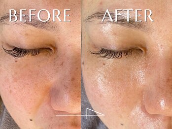 神門 メディカルラボ MEILI院(MedicalLab)/30代 | 女性 | ハーブピーリング