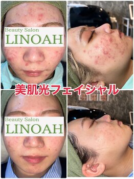 ビューティーサロン リノア(LINOAH)/美肌光フェイシャル＋イオン導入