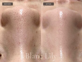 ブランリリー 福岡薬院店(Blanc Lily)の写真/イラストリアス(ホワイトピーリング)で表面的な白さだけでなく肌内部から輝く♪薬院の通いやすいサロン☆