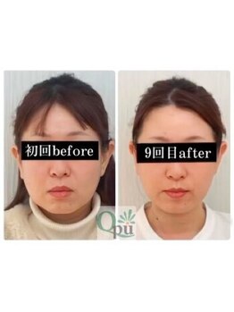 キュープ 前橋店(Qpu)の写真/当店自慢のスペシャルケアで小顔お肌弛み年齢に応じたケアを体験して！