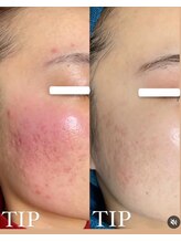 ビーピー 渋谷(b.p.)/TIPハーブピーリング