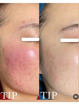 ビーピー 渋谷(b.p.)/TIPハーブピーリング