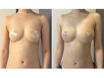 モア(moa)/2回目バスト症例!まんまるバスト