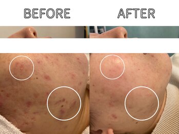 ライム 天神(LIME)/症例写真｜ニキビケア