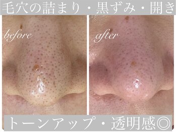 アリスビューティー(AliceBeauty)/毛穴のお悩みなら！