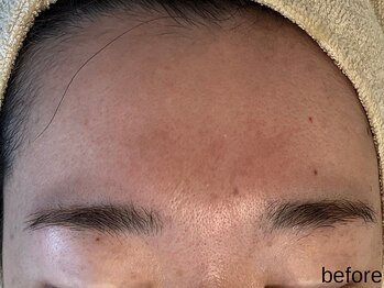 サロン ド エメ(salon de aimer)/【Before】赤み、くすみに!