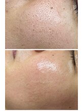 ミーラブ 鹿児島(miilove)/毛穴引き締め肌質改善