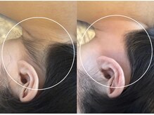 アンベリール(Embellir)/【Lady's】うなじワックス脱毛