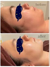 キラキラ 横浜(Kira Kira)/小顔ケアの結果