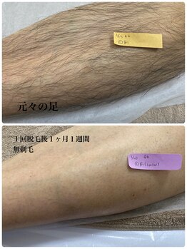 リアナ(liana)/あし脱毛　メンズ