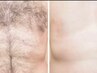 【メンズ脱毛/WAX脱毛】VIO高保湿 敏感肌専用ブラジリアンWAX+二箇所￥10000