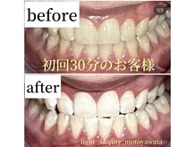 ライトビューティー 本八幡店(LIGHT BEAUTY)/【セルフホワイトニング】
