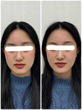 ラフテル鍼灸整骨院/学割U24/成人式前に美容鍼！