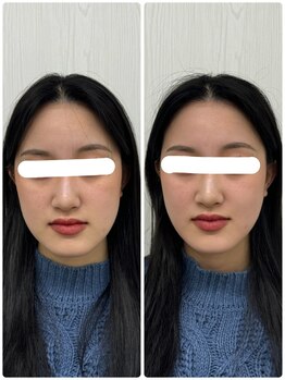 ラフテル鍼灸整骨院/学割U24/成人式前に美容鍼！