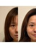 [インディバフェイシャル90分]デコルテ付き美肌小顔リフトアップ・小顔矯正