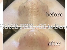 イヨヨ(iyoyo)/BeforeAfter