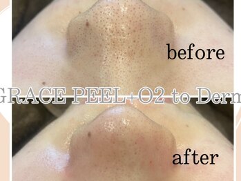 イヨヨ(iyoyo)/BeforeAfter