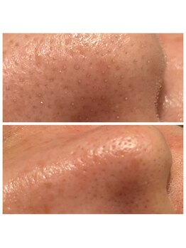 セレア(CELEA)/ハイドロ毛穴洗浄/角栓詰まり