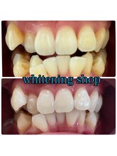 ホワイトニングショップ 豊川店/Before After豊川ホワイトニング