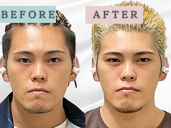 エルシンメトリー矯正院(ailesシンメトリー矯正院)/before＆after　ailes式小顔矯正