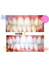 エクシアホワイトニング 高松本店/ホワイトニングビフォーアフター