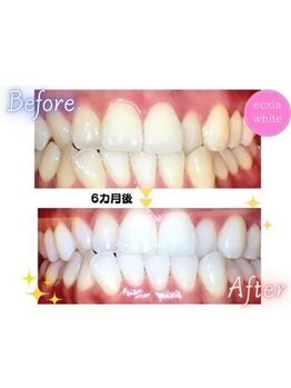 エクシアホワイトニング 高松本店/ホワイトニングビフォーアフター