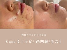 シーヴォーク(Cveauque)/ハーブピーリング｜ハーブリプロ